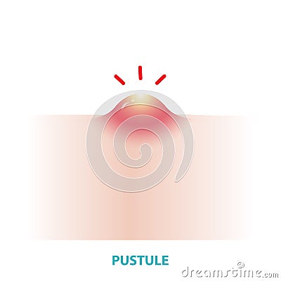 Pustule acne vector illustration isolated on white background. Cartoon Illustration