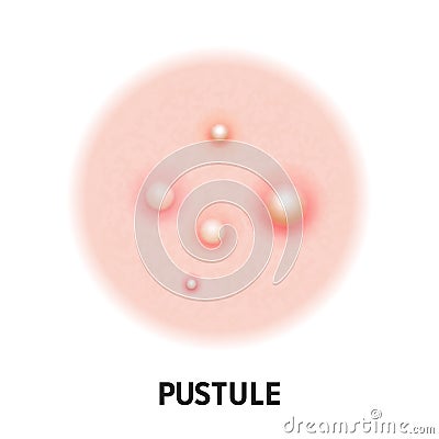 Pustule skin acne type vector icon. Skin disease acne pustules pimples type, face pore comedones Vector Illustration