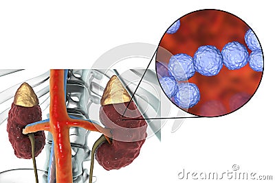 Pyelonephritis caused by bacteria Enterococcus Cartoon Illustration