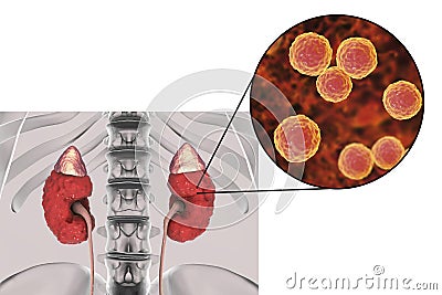 Pyelonephritis caused by bacteria Enterococcus Cartoon Illustration