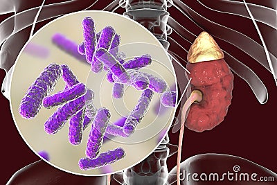 Pyelonephritis, close-up view of bacteria caused kidney inflammation Cartoon Illustration