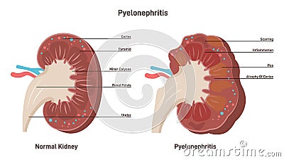 Pyelonephritis. Kidney infection disease, inflammation of organ tissue Vector Illustration