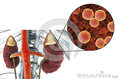 Pyelonephritis caused by bacteria Enterococcus Cartoon Illustration