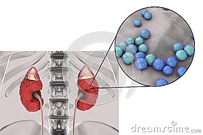 Pyelonephritis caused by bacteria Enterococcus Cartoon Illustration