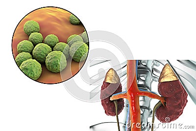 Pyelonephritis caused by bacteria Enterococcus Cartoon Illustration