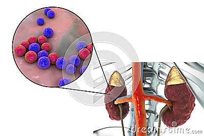 Pyelonephritis caused by bacteria Enterococcus Cartoon Illustration