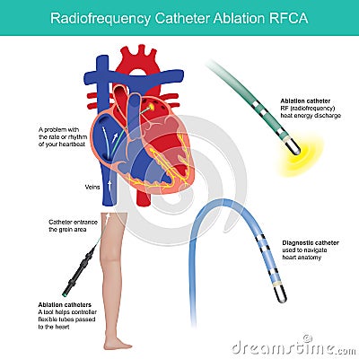 Radio frequency Catheter Ablation. Medical procedure. Stock Photo