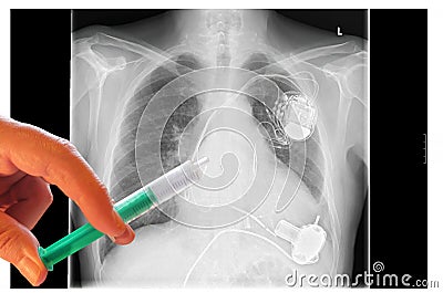 Radiograph, chest, hands with syringe Stock Photo