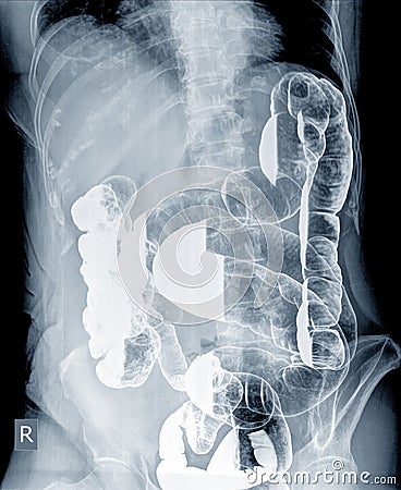 Radiological examination to look for colon abnormalities By enema the barium powder and air into the anus. Stock Photo