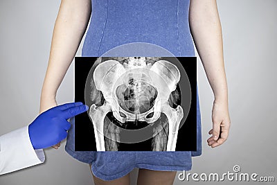 X-ray of the pelvic bones of a woman. Radiologist examines X-ray examination. A picture of the hip joint is superimposed on the pa Stock Photo