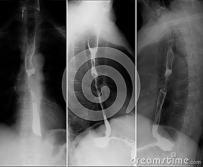 X-ray of the upper gastrointestinal series UGI with barium. Cancer of the esophagus. Stock Photo