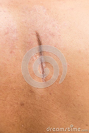 Raised scar. scar after appendectomy. cyanotic keloid scar caused by surgery and suturing, skin imperfections or defects. Stock Photo