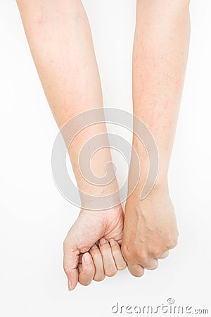 Rash allergy from touching arms ,eczema, Dermatitis Stock Photo