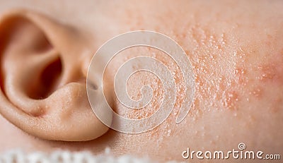 rash or red pimples allergic skin on baby cheek Stock Photo