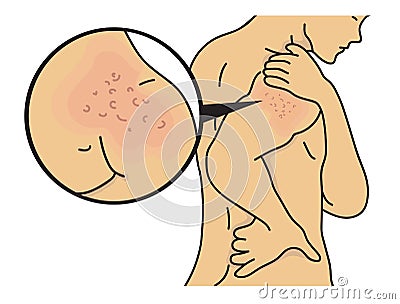 Rash on shoulder Vector Illustration