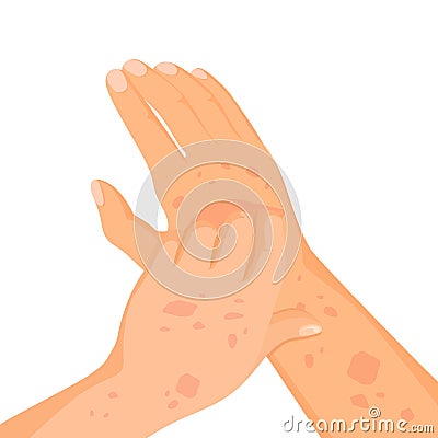 Rash skin on hand. Rashes itching hands scratch arm in red spot, dermatitis allergy symptoms itchy hives medicine pele Vector Illustration