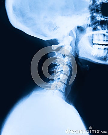 Ray x imaging of the cervical spine Stock Photo