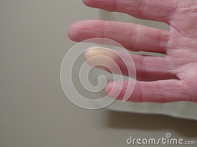 Raynaud's Syndrome Phenomenon hand pain circulatory neurological rheumatic cold skin medical male female Raynaud's Stock Photo