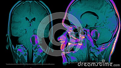 Real Life Man Brain Mri Scan with Tumor Neoplasm Medical Reseach New  Quality Health Science 4k Footage Stock Animation Stock Footage - Video of  diagnostic, pattern: 143716504