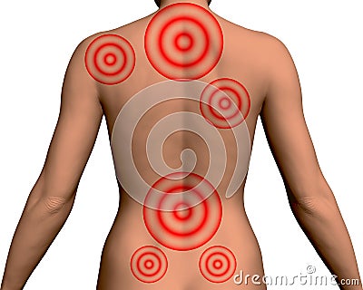 Realistic back of a slender girl with red circles at the pain points of the back. 3D. Vector illustration Vector Illustration