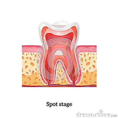 Realistic Caries Tooth Anatomy Vector Illustration