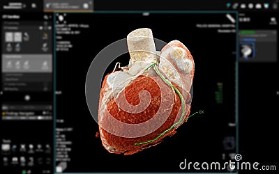 Realistic 3D Heart CTA Scan:.A detailed CTA scan showing the coronary arteries and heart structure, providing a comprehensive view Stock Photo