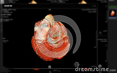 Realistic 3D Heart CTA Scan:.A detailed CTA scan showing the coronary arteries and heart structure, providing a comprehensive view Stock Photo