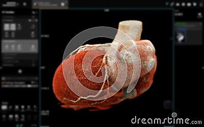 Realistic 3D Heart CTA Scan:.A detailed CTA scan showing the coronary arteries and heart structure, providing a comprehensive view Stock Photo