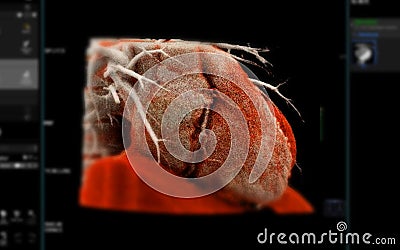 Realistic 3D Heart CTA Scan:.A detailed CTA scan showing the coronary arteries and heart structure, providing a comprehensive view Stock Photo