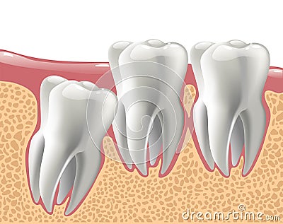 Realistic 3D teeth, and wisdom tooth problems Vector Illustration