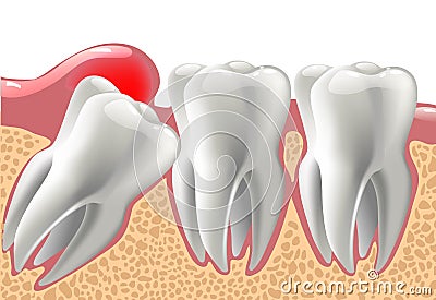 Realistic 3D teeth, and wisdom tooth problems Vector Illustration
