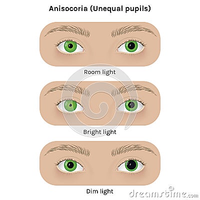 Realistic human eyes with anisocoria vector illustration design Vector Illustration