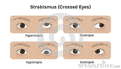 Realistic human eyes with strabismus vector illustration design. Vector Illustration