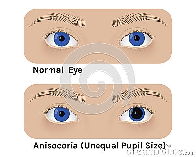Realistic human normal eyes and with anisocoria Vector Illustration