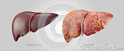 Realistic illustration of healthy and sick human livers Cartoon Illustration