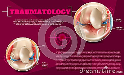 Realistic Illustration Traumatology Medicine in 3d Vector Illustration