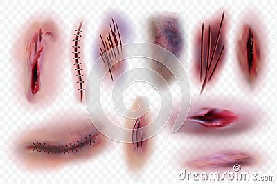 Realistic scars. Wound, surgical stitches and bruis, skin cuts. Bloody wounds vector isolated set Vector Illustration