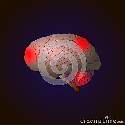 Realistic Vector Medical illustration. Diseases of the brain with points of pain Cartoon Illustration