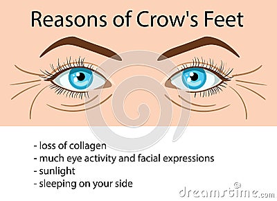 Reasons od Crows feet wrinkles, vector illustration Vector Illustration