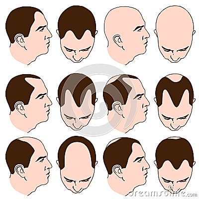 Receding Hairlines Vector Illustration