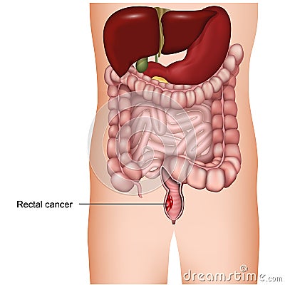 Rectal cancer medical 3d illustration on white background, colorectal cancer Cartoon Illustration