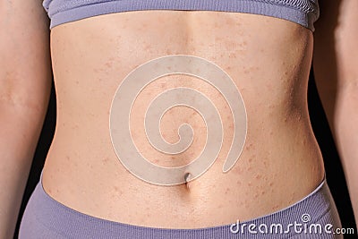 Red allergic rash on stomach skin, skin allergy, atopic dermatitis, eczema. Woman applying ointment Stock Photo