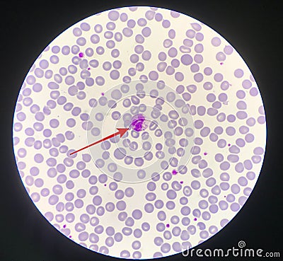 Red arrow showing neutrophil with toxic granule Stock Photo