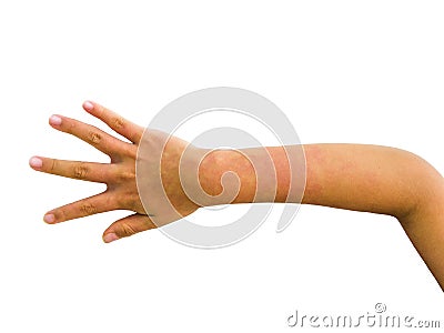 Red birthmark on child right arm isolated on white background. Stock Photo