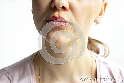 Red bubbles of herpes on lips of a woman in light pink t-shirt, lower part face is seen. Medicine, treatment Stock Photo