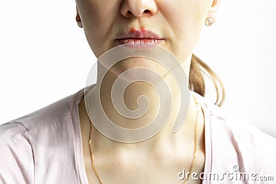 Red bubbles of virus herpes on lips of a woman in light pink t-shirt, lower part face is seen. Medicine, treatment Stock Photo