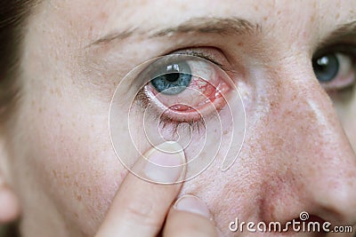 Red eye after hayfever attack Stock Photo