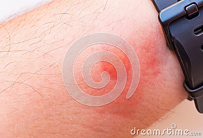 Insect bite on a men's hand. Allergic reaction. Stock Photo