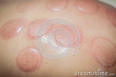 Red marks, cupping therapy, vacuum spots on woman back Stock Photo
