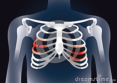 Red signal at the bones in rib cage break. Vector Illustration